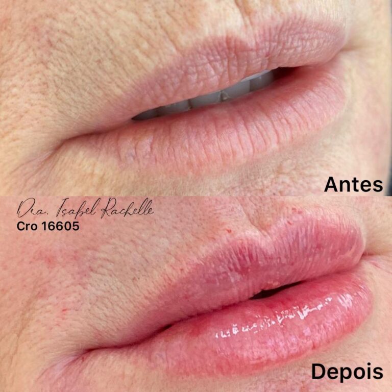 preenchimento labial