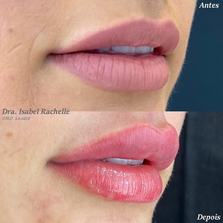 preenchimento labial