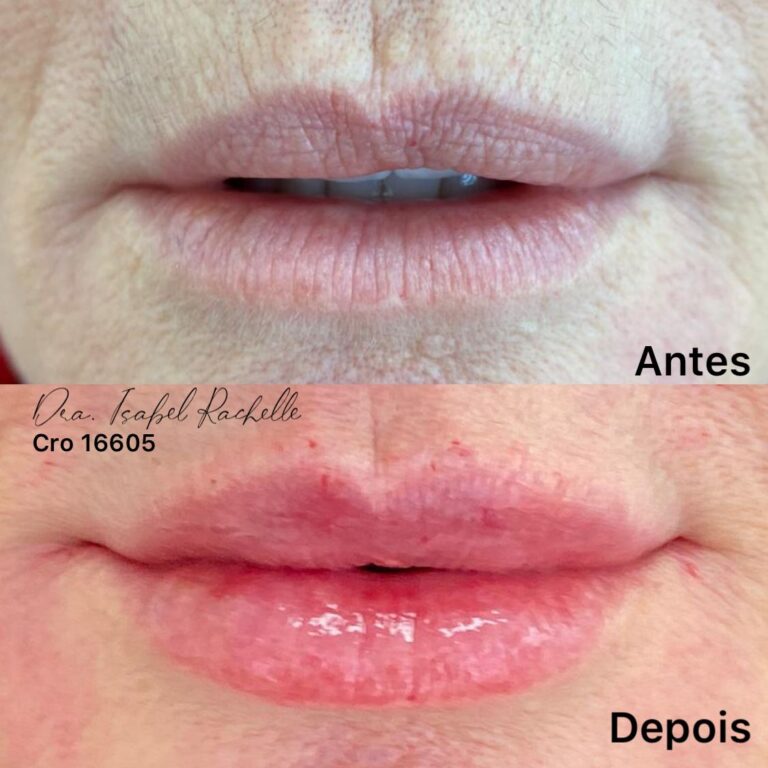 preenchimento labial
